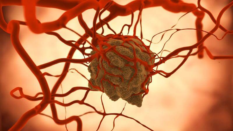 Metastazik Kanser Nedir? Belirtileri Nelerdir? 15 metastazik-kanser